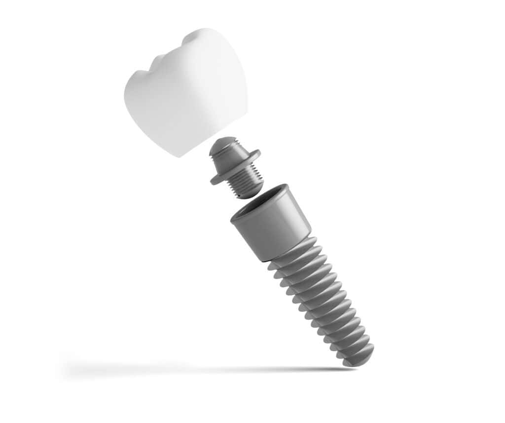 dental prosthesis