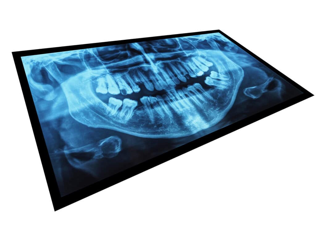 Medical Xray of teeth